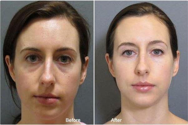 Juvederm filler before after-eyes