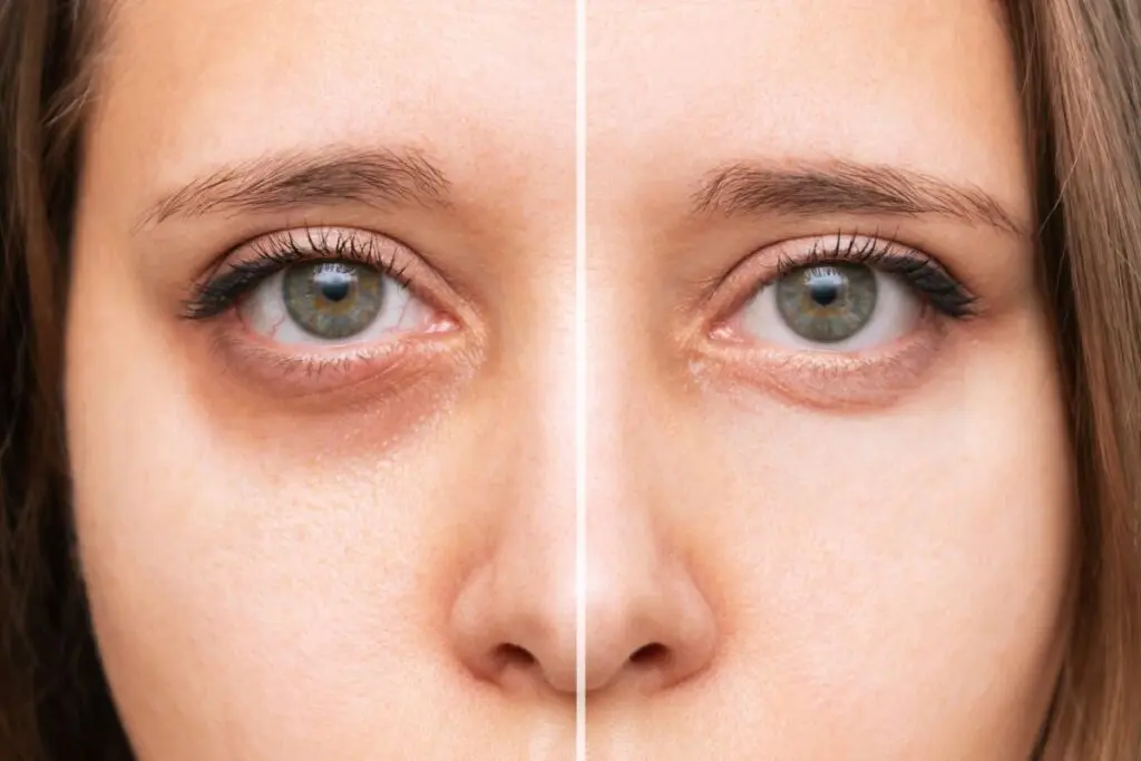 Before After Under-Eye Fillers Huntington Beach