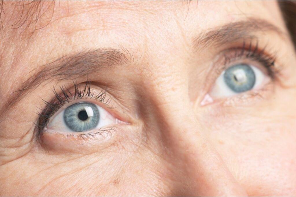 Botox for Crow's Feet
