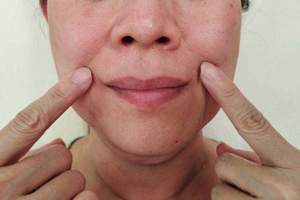 Botox for Smile Lines in Huntington Beach