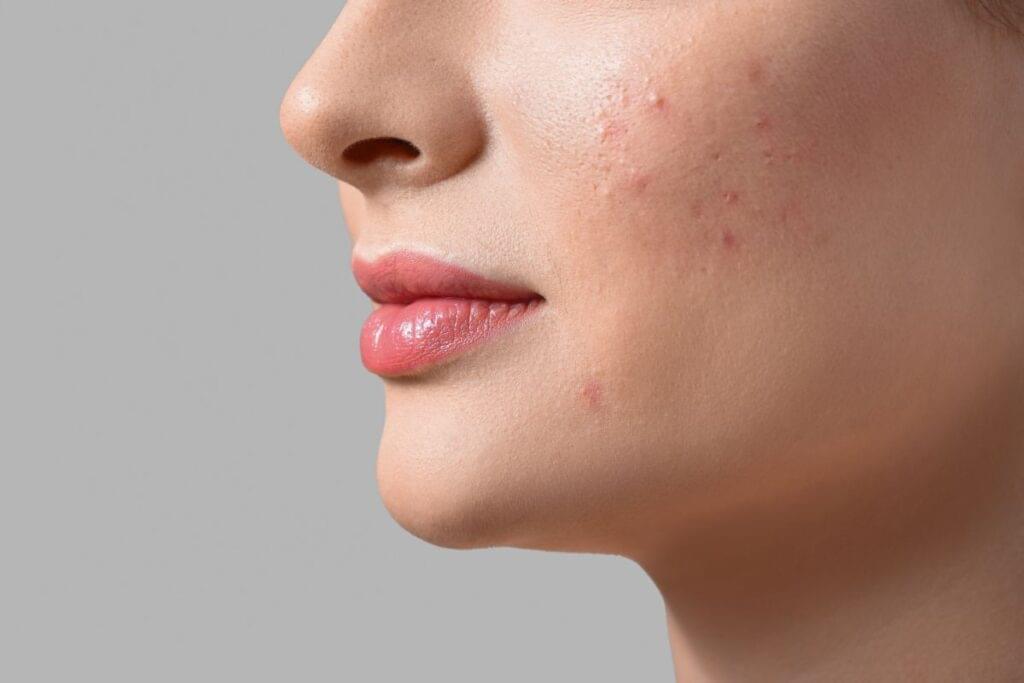 Botox for acne in Huntington Beach