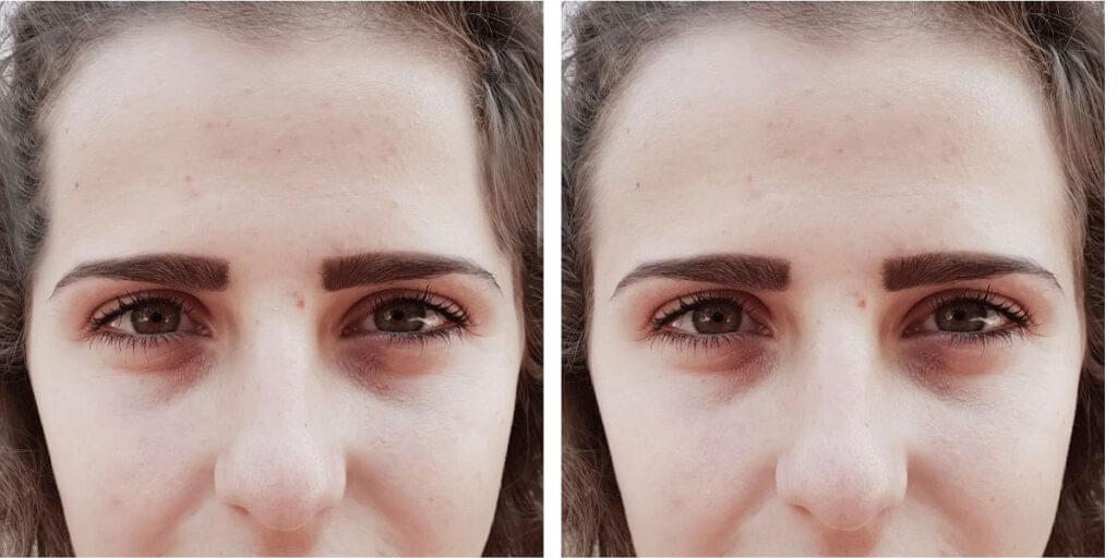 before after temple fillers huntington beach