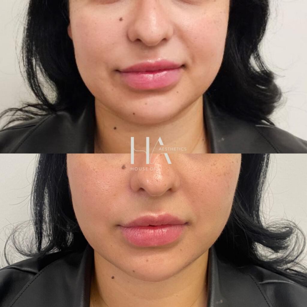 chin filler before after