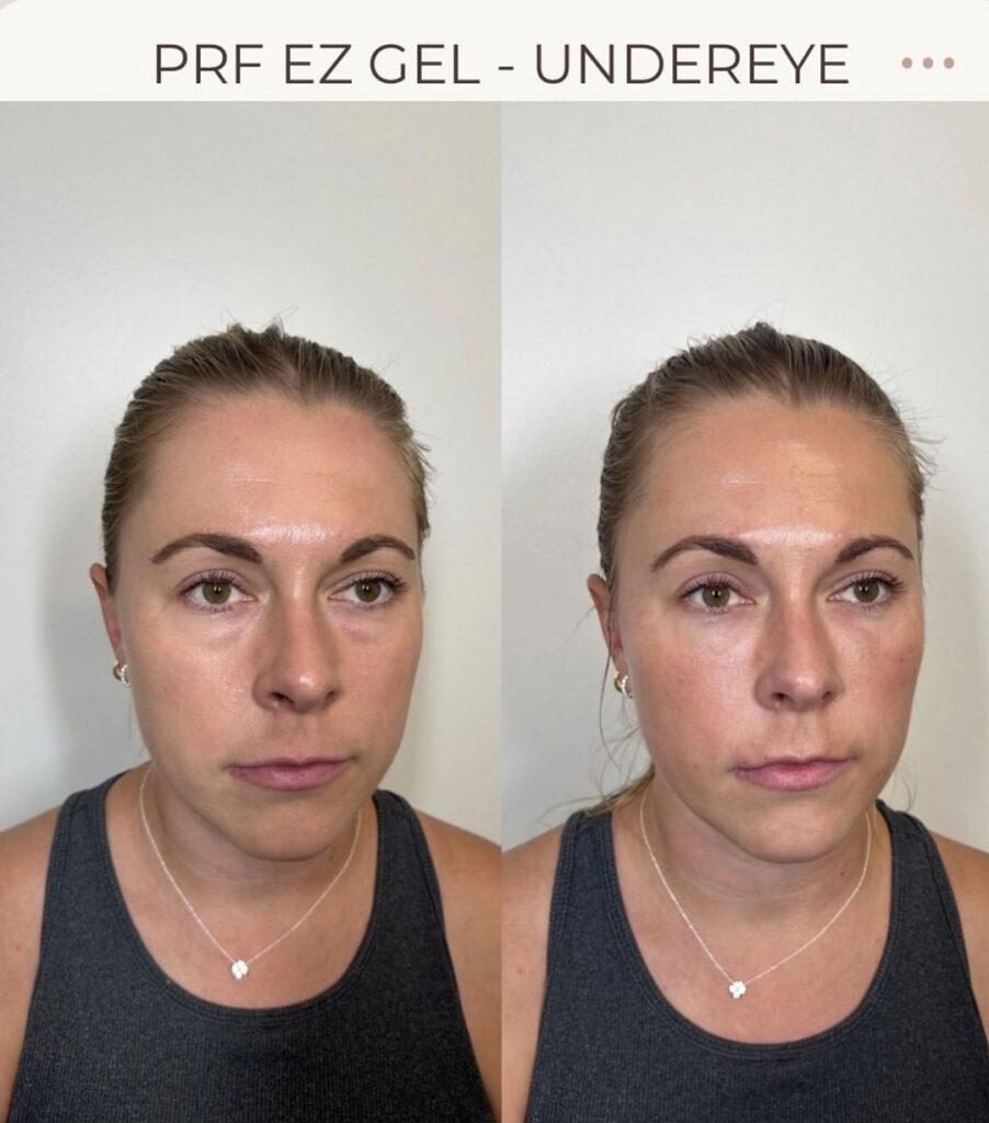 prf-ez-gel-under-eye-before-after-1