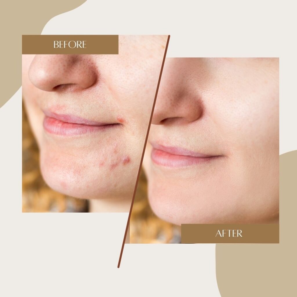 Refined natural results before and after at House of aesthetics med spa huntington beach